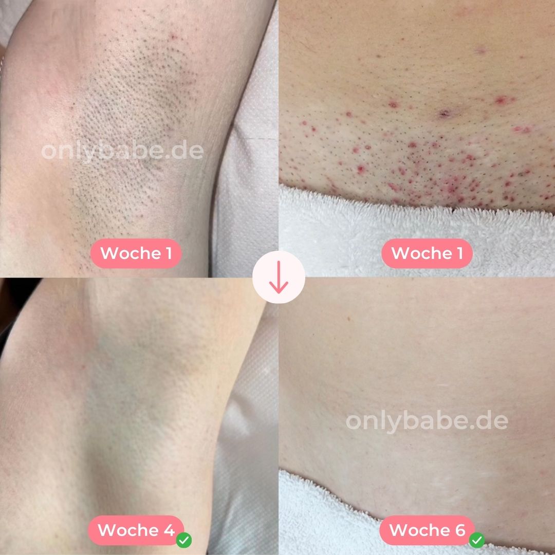 ONLYBABE IPL PRO™