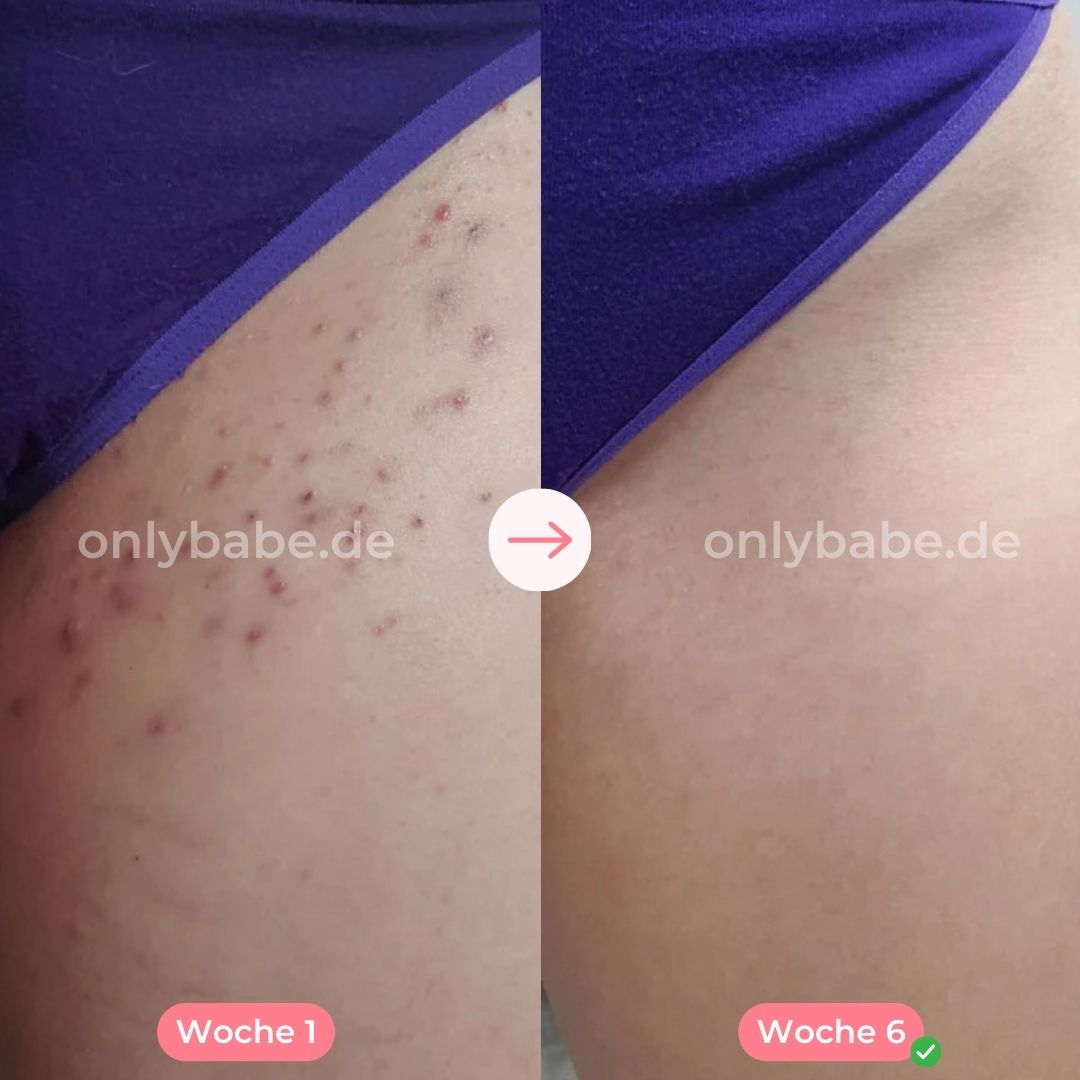 ONLYBABE IPL PRO™
